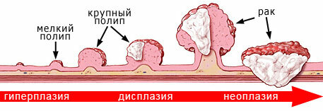 Intestinal tumors