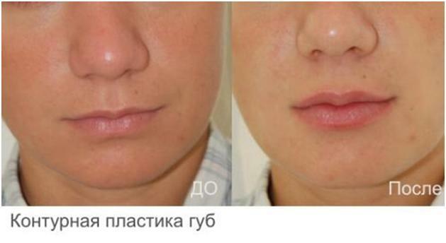 lèvres agrandies avant et après les photos