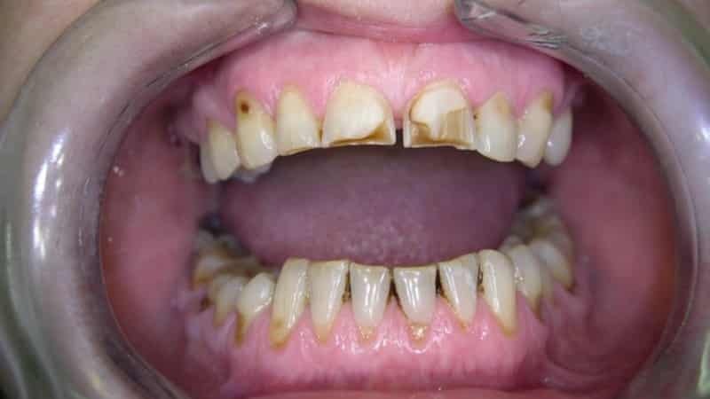 Pasta de dientes por enfermedad periodontal