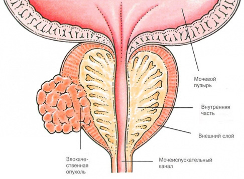 Symptome von Prostatakrebs und Behandlungsmethoden