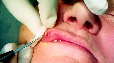 Surgical removal of warts