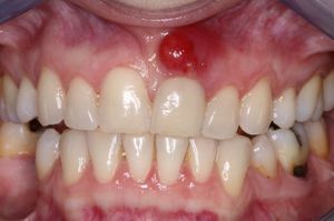 tand flux behandling hos voksne med antibiotika og folkemusik retsmidler, indikationer og kontraindikationer for behandling af