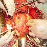 Chirurgie van peritonitis, abdominale sepsis