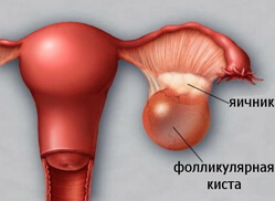 Folikularna slika crijeva jajnika