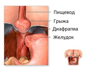 Diaphragmatic hernia disease