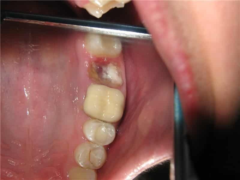 ontsteking na tandextractie putjes behandeling