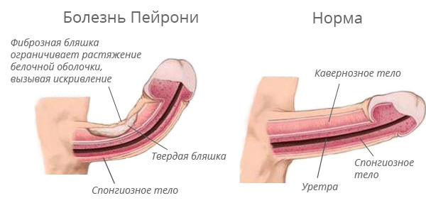 Curvature of the penis with a cavity