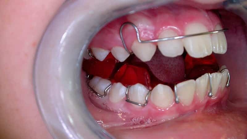 Plate på tänderna