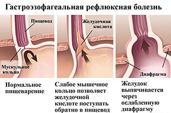 Gastroezofaginio refliukso liga