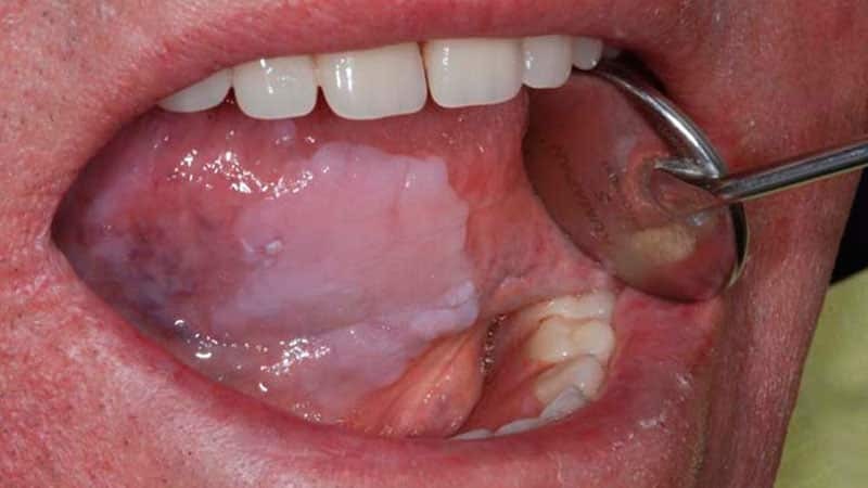 Kuidas ravida stomatiit suus
