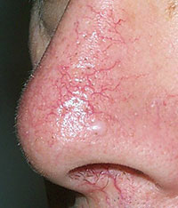 Removal of vascular asterisks on the face