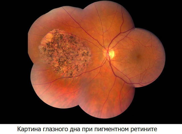 retinti-eye