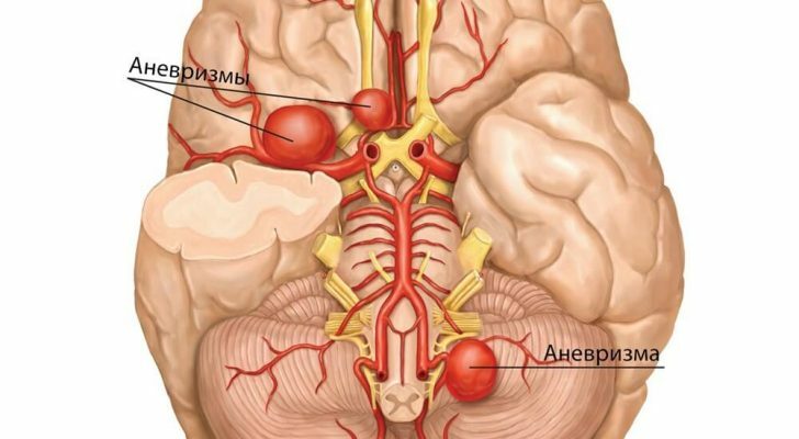 aneurizmu, vaskularno-cerebralne mozga