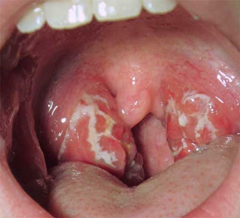 Ulcers on tonsils
