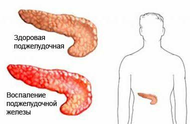 Pankreatitis