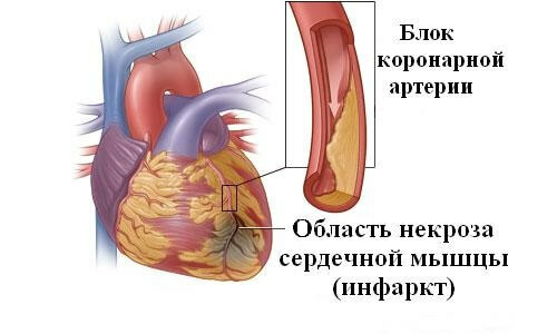 Risikoen for hjerteinfarkt, som lider på føttene