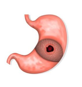 Úlcera estomacal