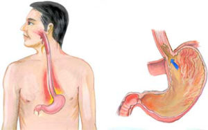 Feeling of heartburn