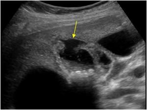 Cholecystitis met stenen