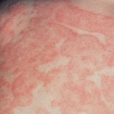 Atopowe zapalenie skóry: leczenie środkami ludowymi