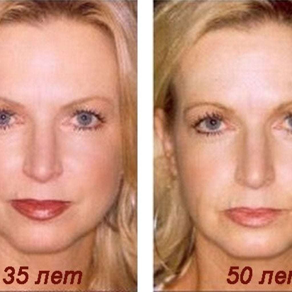 Bags under the eyes: causes and treatment in women after 50 years