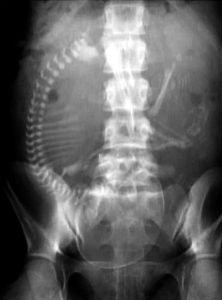 Abdominale röntgenfoto