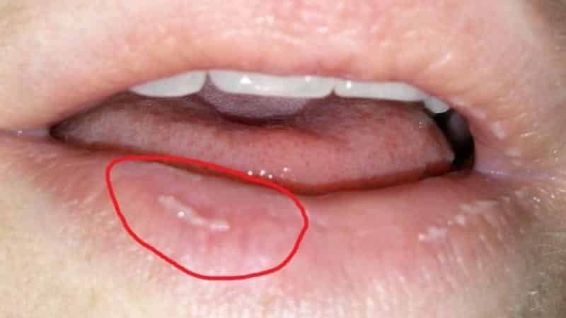 manchas brancas na boca após o sono