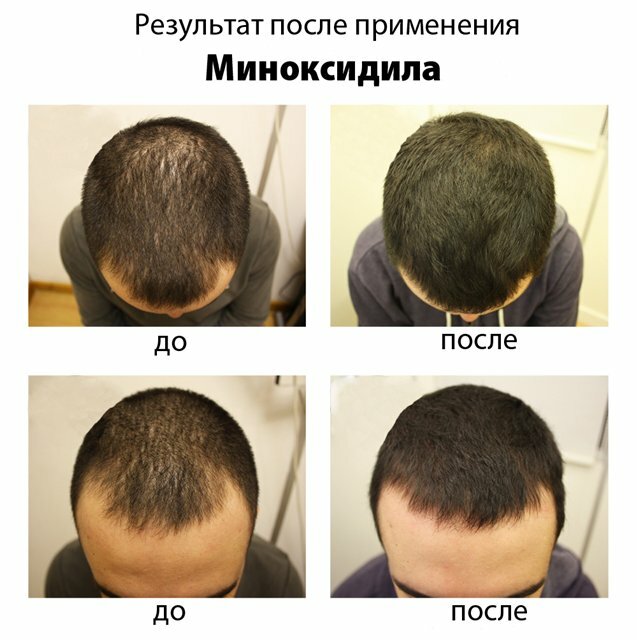 Liječenje androgenetic alopecija