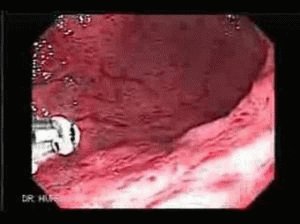 Površinski gastroduodenitis: uzroci, simptomi i liječenje