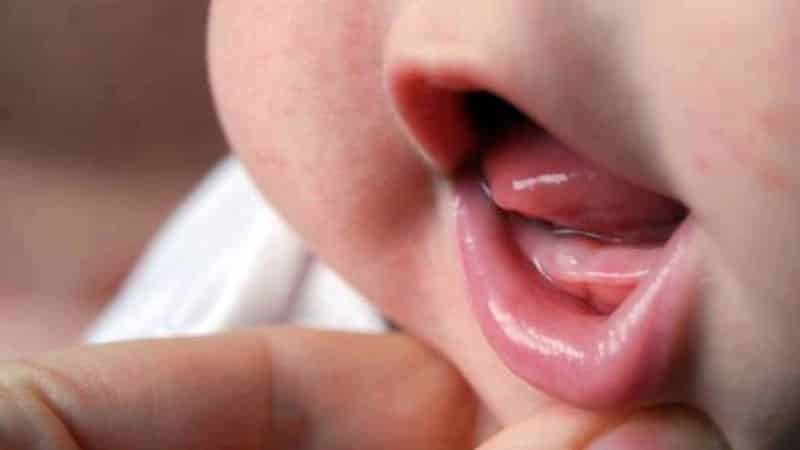 Gum sygdom hos børn: behandling, symptomer, fotos
