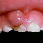 Geschwollenes Zahnfleisch und Zahnschmerzen, die tun