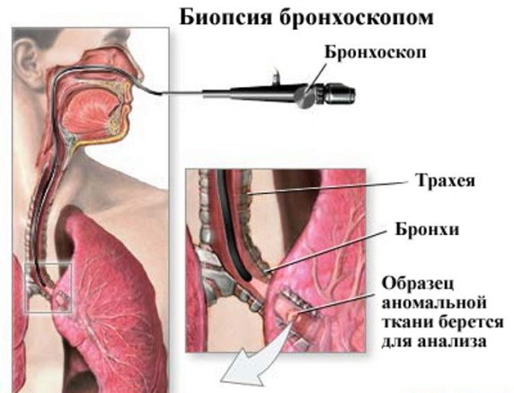 3 bronchobiopsy