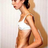 Drugs for the treatment of anorexia nervosa