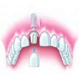 Implantation of teeth under general anesthesia