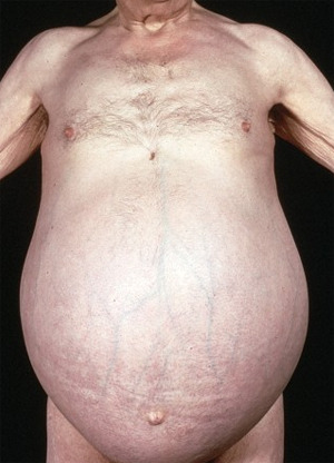 Leverascites