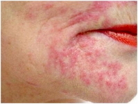 Allergische Dermatitis: symptomen en de behandeling