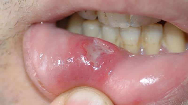 úlceras na boca