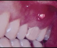 How to treat a tooth fistula?