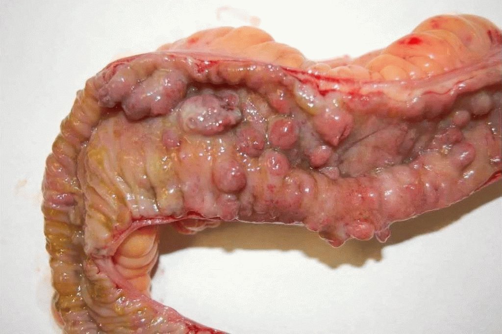 ziekte van Crohn