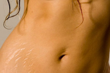 Reasons for the appearance of stretch marks