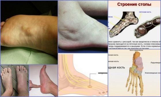 Što je metatarsalgia stopala i kako se liječi?