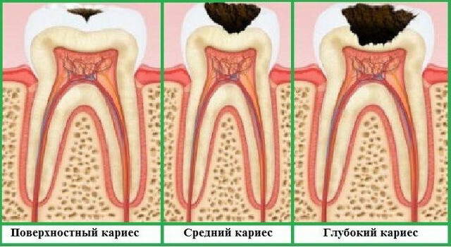 How to remove a toothache at home without pills?
