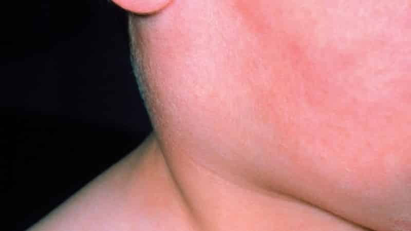 Lymfadenitt submandibular: årsakene til og kur