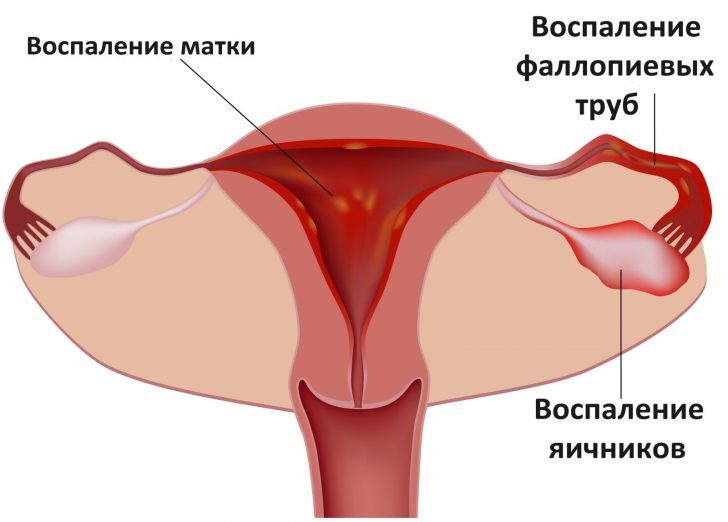 Inflammation-ovary-photo