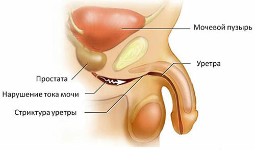 Buzhirovanie urethra with stricture