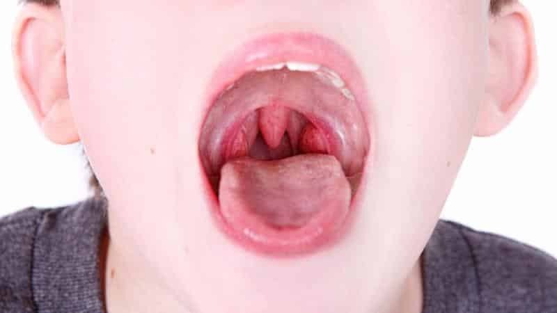 ob es notwendig ist, die Mandeln in der chronischen Tonsillitis zu entfernen