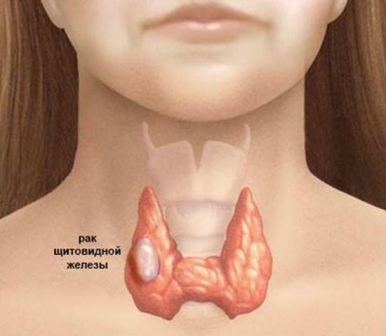 tumeur de la thyroïde, symptômes de la maladie, le diagnostic et le traitement