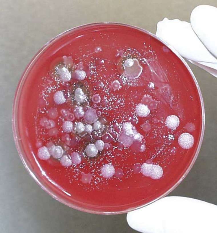 Anthrax: diagnose, behandeling en preventie