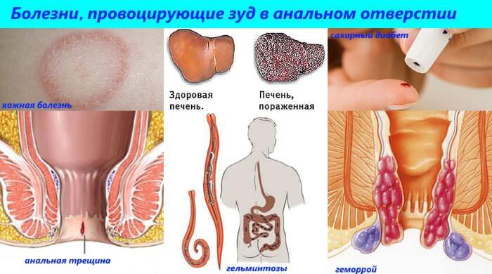 Diseases that provoke itching in the anus