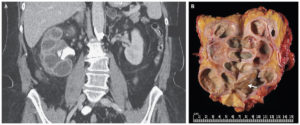 A pyelonephritis betegsége